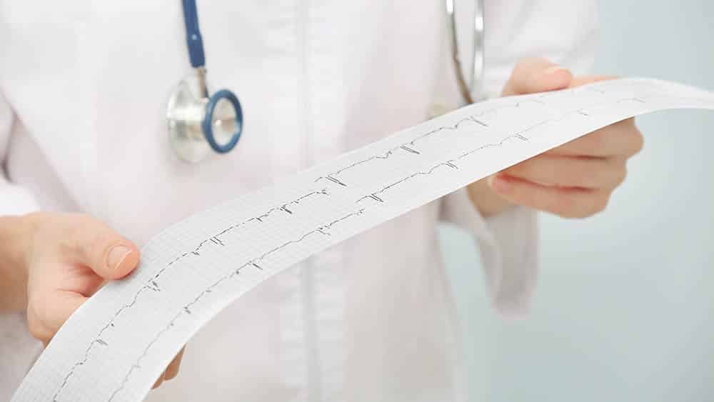 Arritmia (palpitação) Mãos de médica segurando um resultado de eletrocardiograma, um dos exames usados para identificar uma arritmia.