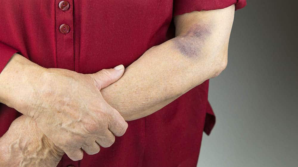 braço de uma mulher com mancha roxa típica dos sintomas de púrpura.