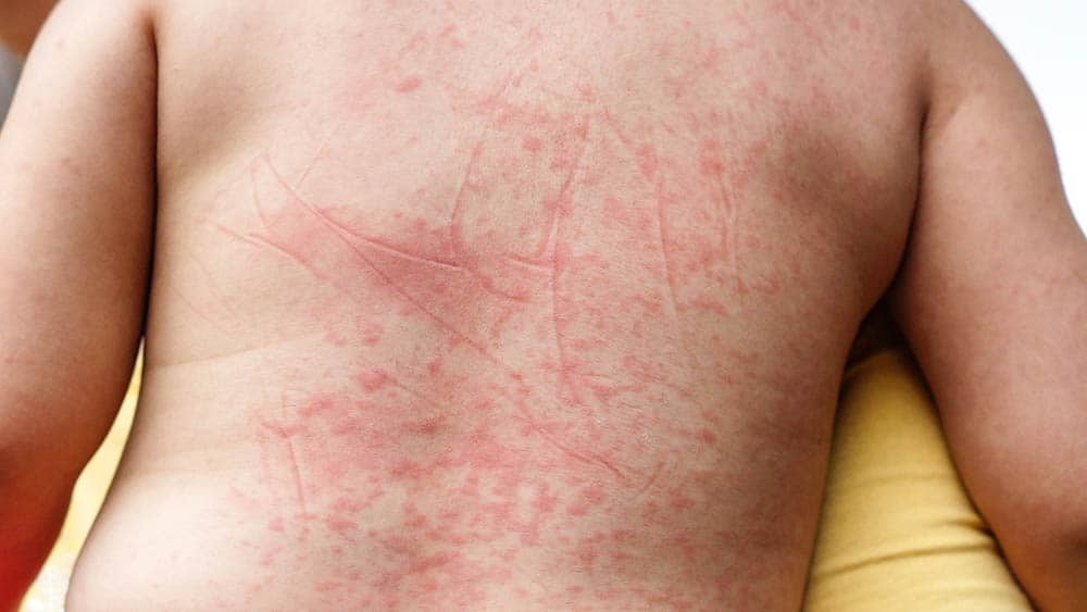 Costas de bebê com manchas vermelhas causadas pela dengue.