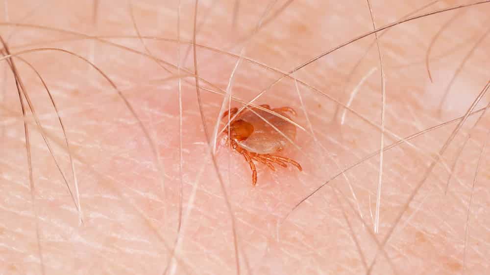 Close de carrapato-estrela em pele humana sugando sangue.
