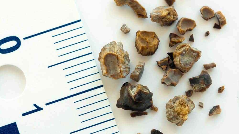 Pedras expelidas em um caso de pedra nos rins, com uma régua ao lado dando a dimensão de cálculos em torno de 0,5 centímetros.