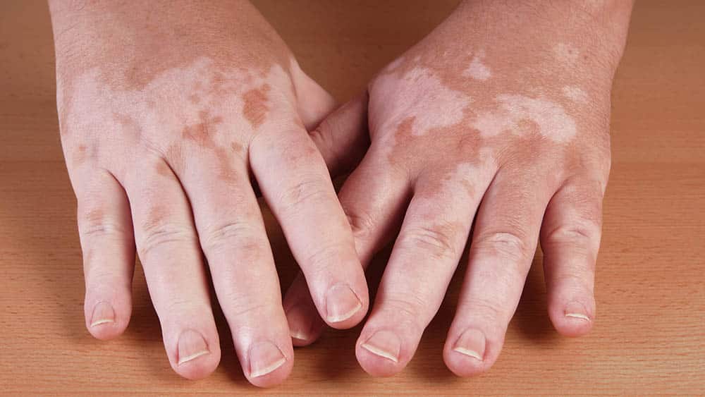 Vitiligo Close de mãos de um paciente de vitiligo.