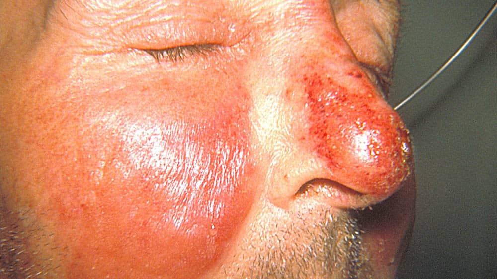 Erisipela Close na região do nariz e das bochechas de um homem atingidas por erisipela, caracterizada por manchas vermelhas dolorosas.