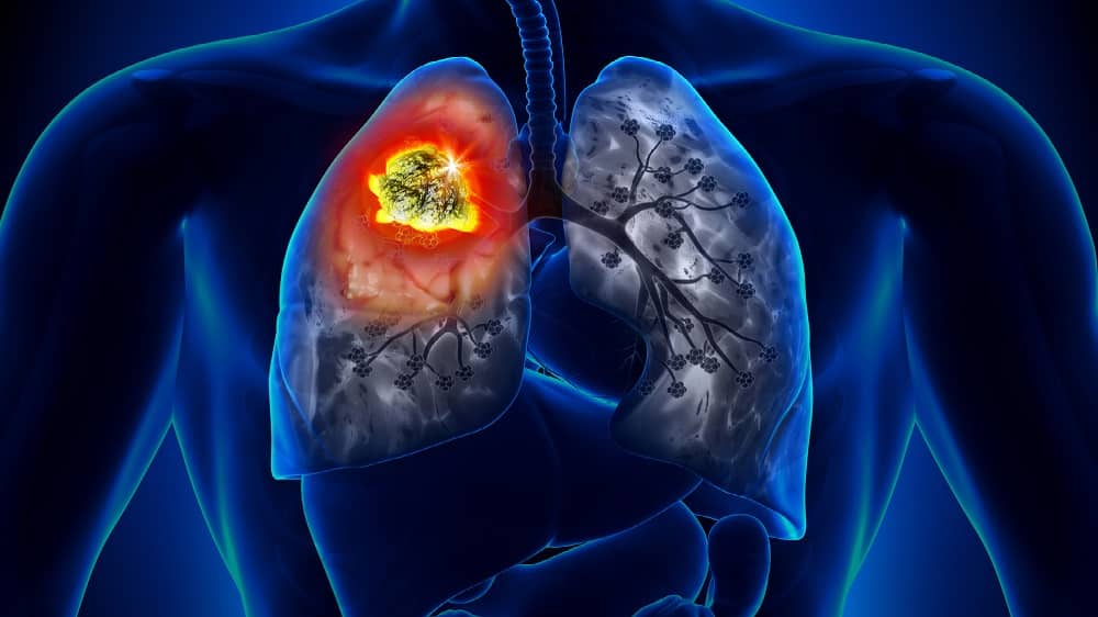 Ilustração de um tumor representando o câncer de pulmão
