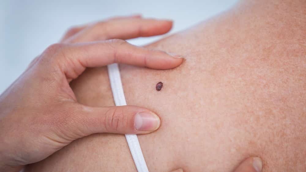 Dermatologista examina pinta que pode indicar câncer de pele