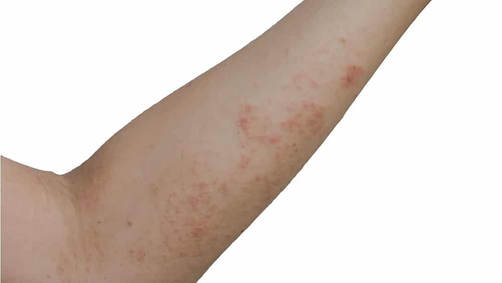 Pitiríase Braço com pequenas lesões na pele, semelhante às lesões causadas por pitiríase