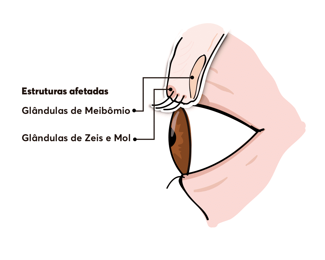 Diferença entre terçol e calázio se dá pelas glândulas afetadas.
