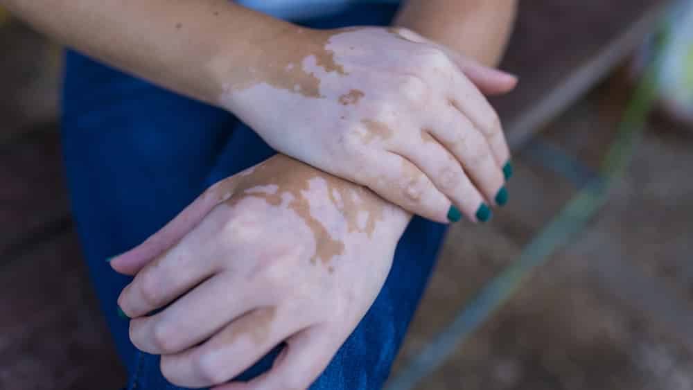 Métodos de tratamento do vitiligo incluem radiação ultravioleta, aplicações de cremes e até cirurgia. Leia mais no artigo do dr. Drauzio.
