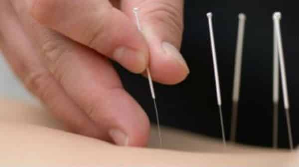 A eficácia da acupuntura no tratamento de dor lombar | Artigo A eficácia da acupuntura no tratamento de dor lombar | Artigo