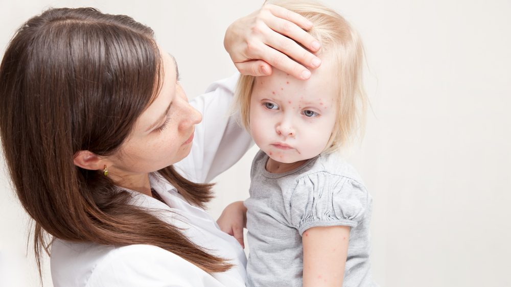 mãe segurando a filha com catapora no colo