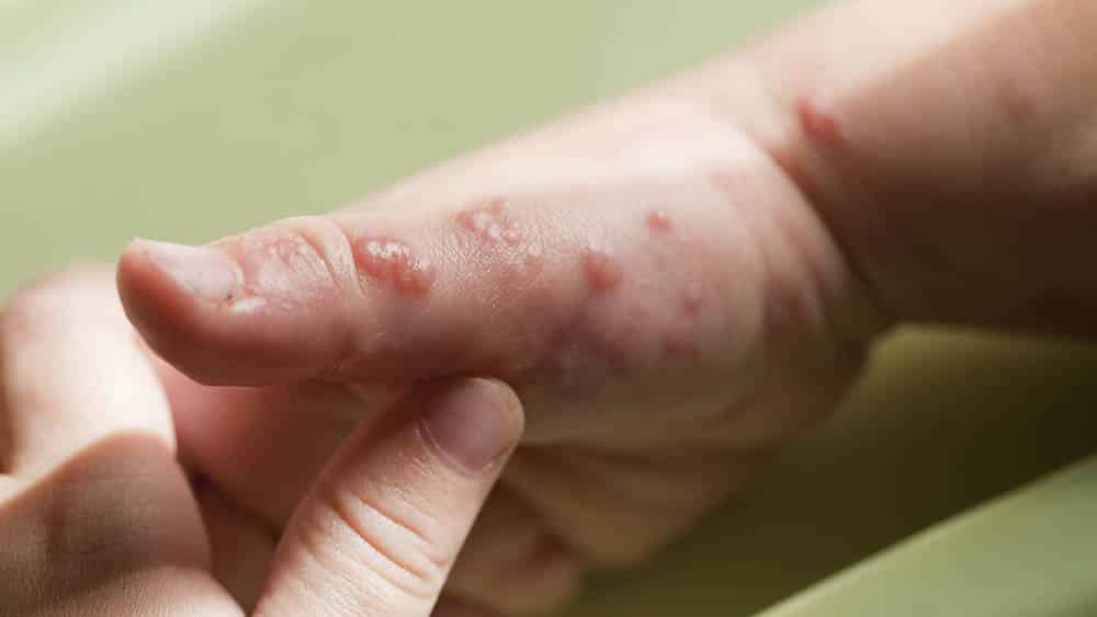 giardia sintomas na pele