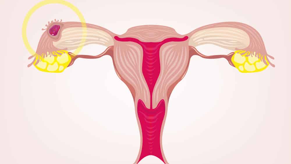Veja entrevista sobre laqueadura, um processo de esterilização definitiva, que consiste no fechamento das tubas uterinas para impedir a descida do óvulo e a subida do espermatozoide.