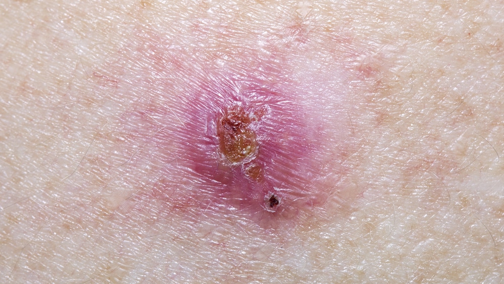 O carcinoma basocelular de pele é uma lesão maligna de crescimento lento e com origem nas camadas basais da epiderme. É um dos mais frequentes dentre os tipos de câncer de pele.