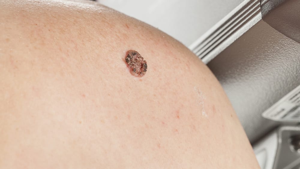 O carcinoma epidermoide de pele é um tipo de tumor maligno que surge especialmente nas regiões do corpo mais expostas à radiação solar, como o rosto, cabeça, pescoço, braços, mãos e pés.