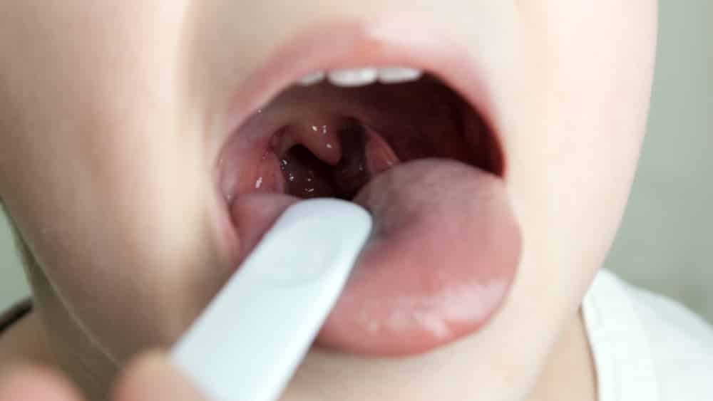 Difteria (ou crupe) é uma doença respiratória infectocontagiosa que tem como sintoma característico o aparecimento de placas pseudomembranosas, acinzentadas e firmes nas amídalas e órgãos adjacentes.