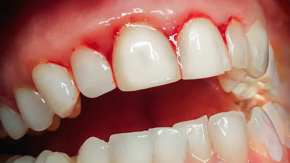 A gengivite é uma inflamação da gengiva causada pela placa bacteriana, também chamada de biofilme, uma fina película que adere à superfície dos dentes e deposita-se no sulco gengival.