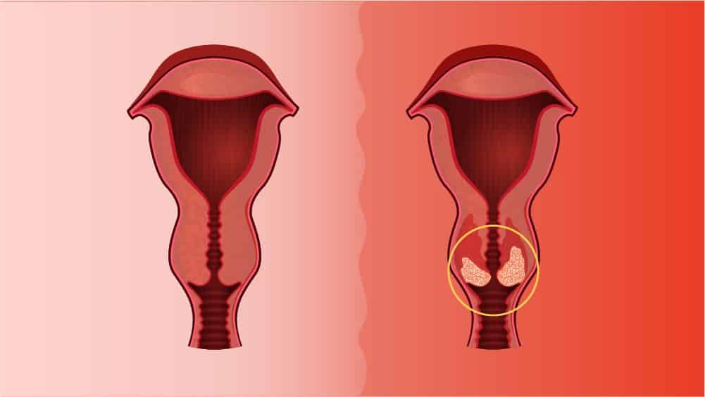 Cancerul de col uterin: infecţia cu HPV şi tratament, Hpv y cancer de colon