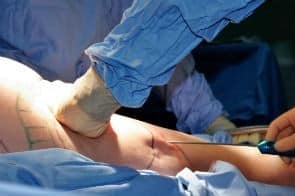 Riscos da lipoaspiração Riscos da lipoaspiração