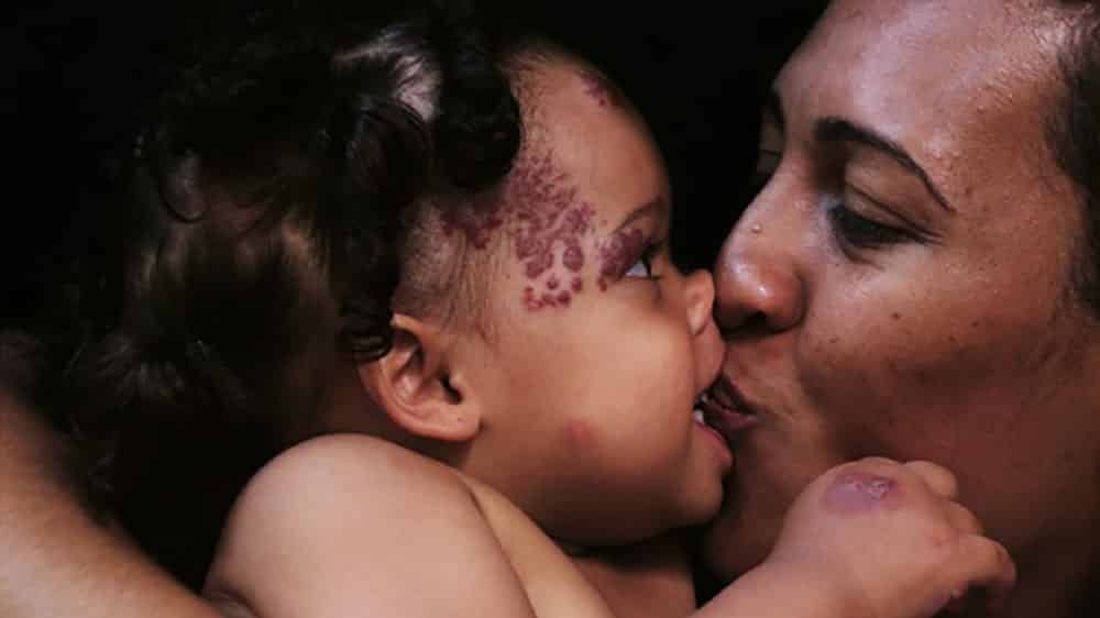 Exposição retrata preconceito em relação a doenças de pele Retrato da exposição Além da Pele, de 2013, com mãe beijando sua filha com lesões de pele no rosto.