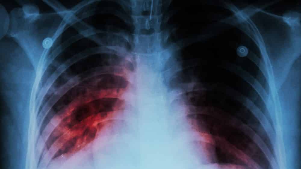 radiografia de pulmão de paciente com tuberculose