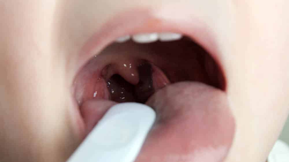 Criança de boca aberta com abaixador de língua para visualização das amídalas.