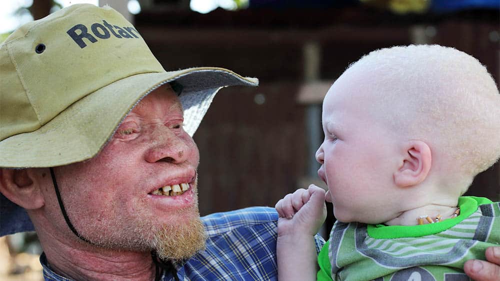 Pai e filho albinos.