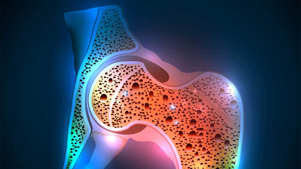 Ilustração com osso do quadril em corte mostrando áreas mais porosas, sinais de osteopenia.