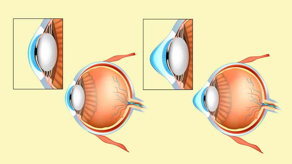 Ilustrações comparando perfis de um olho normal e um olho com ceratocone.