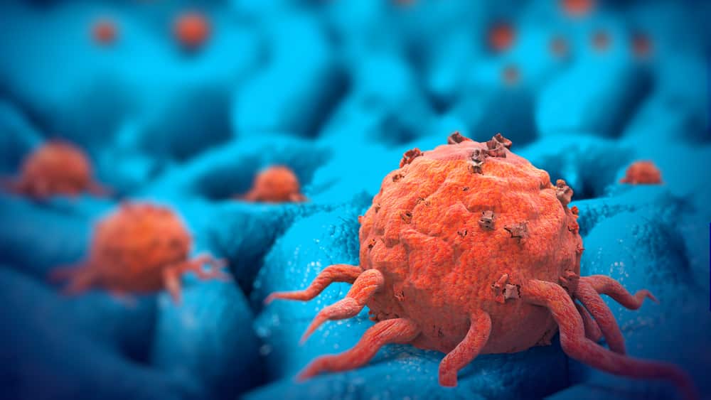 O mieloma é um tumor maligno que se desenvolve nas células plasmáticas, responsáveis pela produção dos anticorpos que compõem o sistema de defesa do organismo