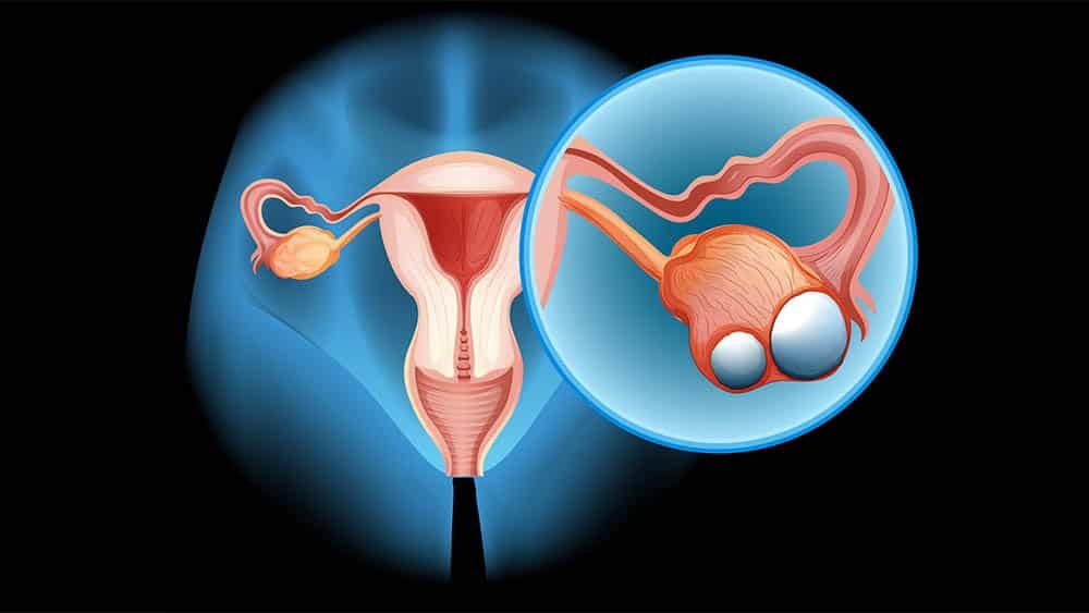Como detectar o câncer de ovário o mais cedo possível Ilustração de sistema reprodutor feminino destacando tumor em um dos ovários.