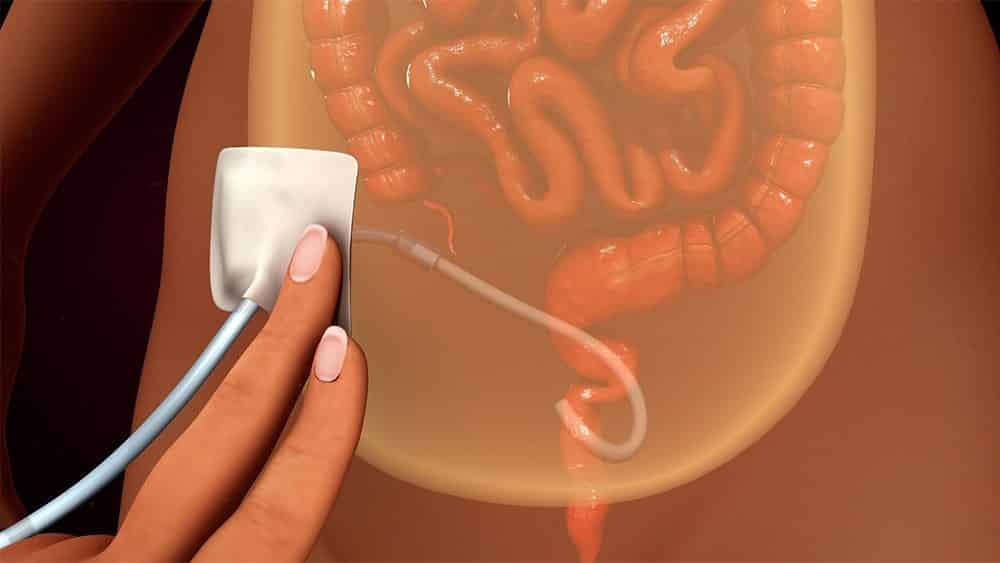 Ilustração digital mostrando catéter na região do abdômen usado para diálise peritoneal.