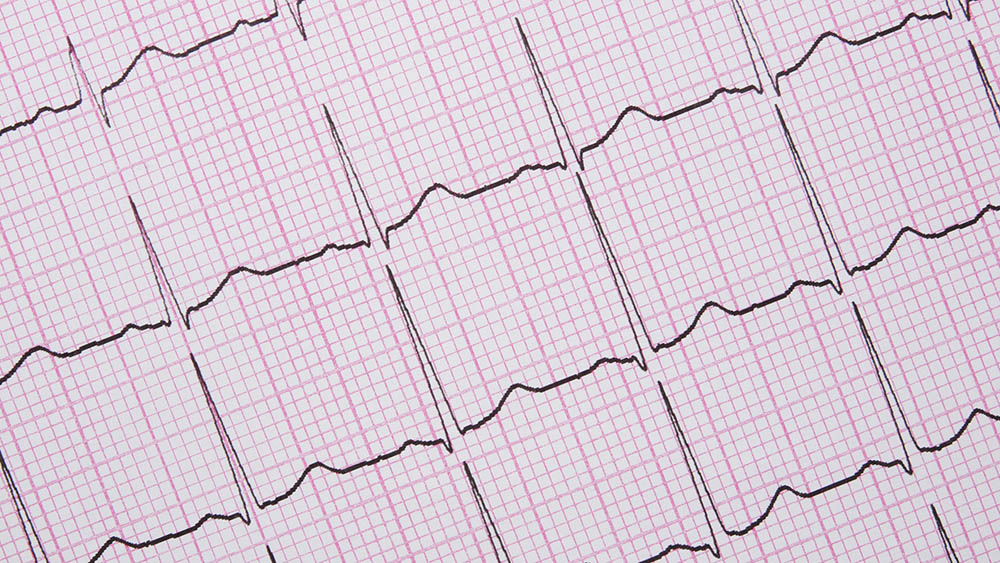 Eletrocardiograma.