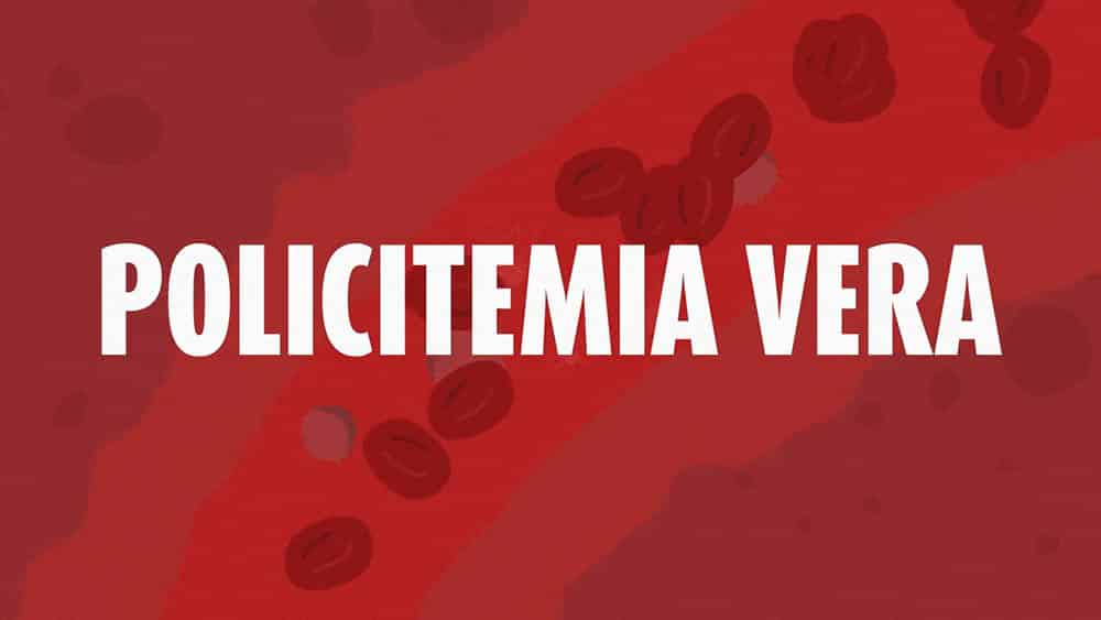 thumb policitemia vera