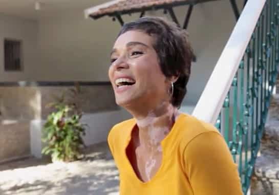 Modelo Eliane Medeiros, portadora de vitiligo.