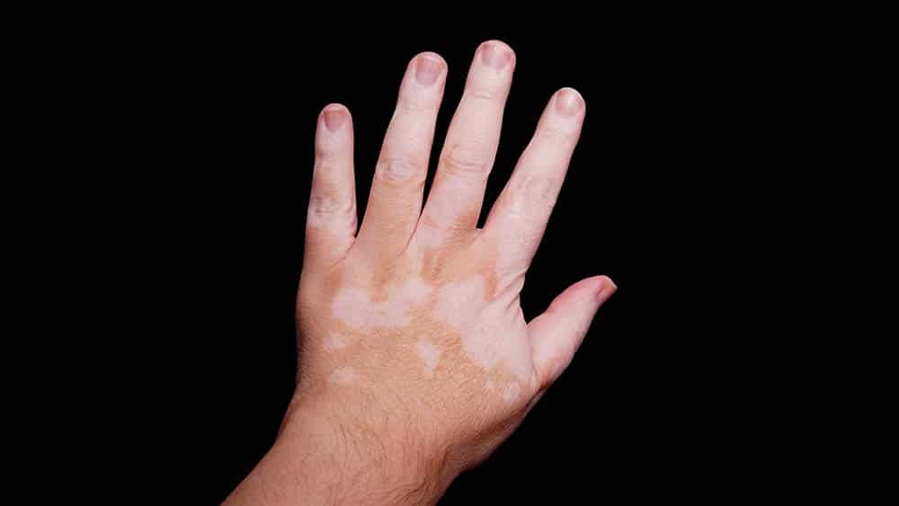 Estresse pode desencadear e agravar vitiligo vitiligo pele dermato