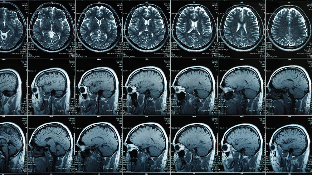 cerebro ressonancia tomografia