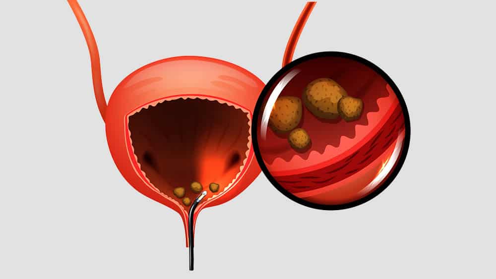chirurgia laser prostatica canada