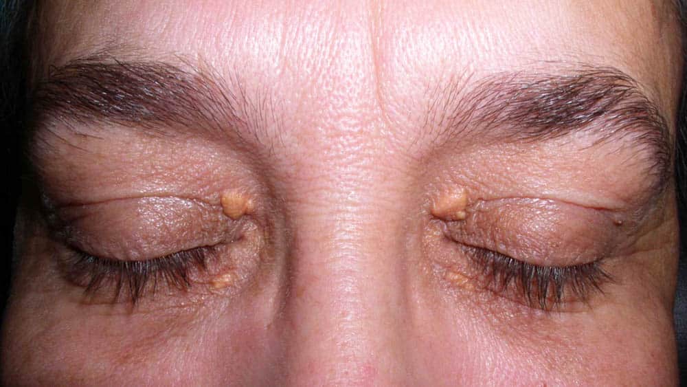 Mulher de olhos fechados com xantelasmas nas pálpebras.