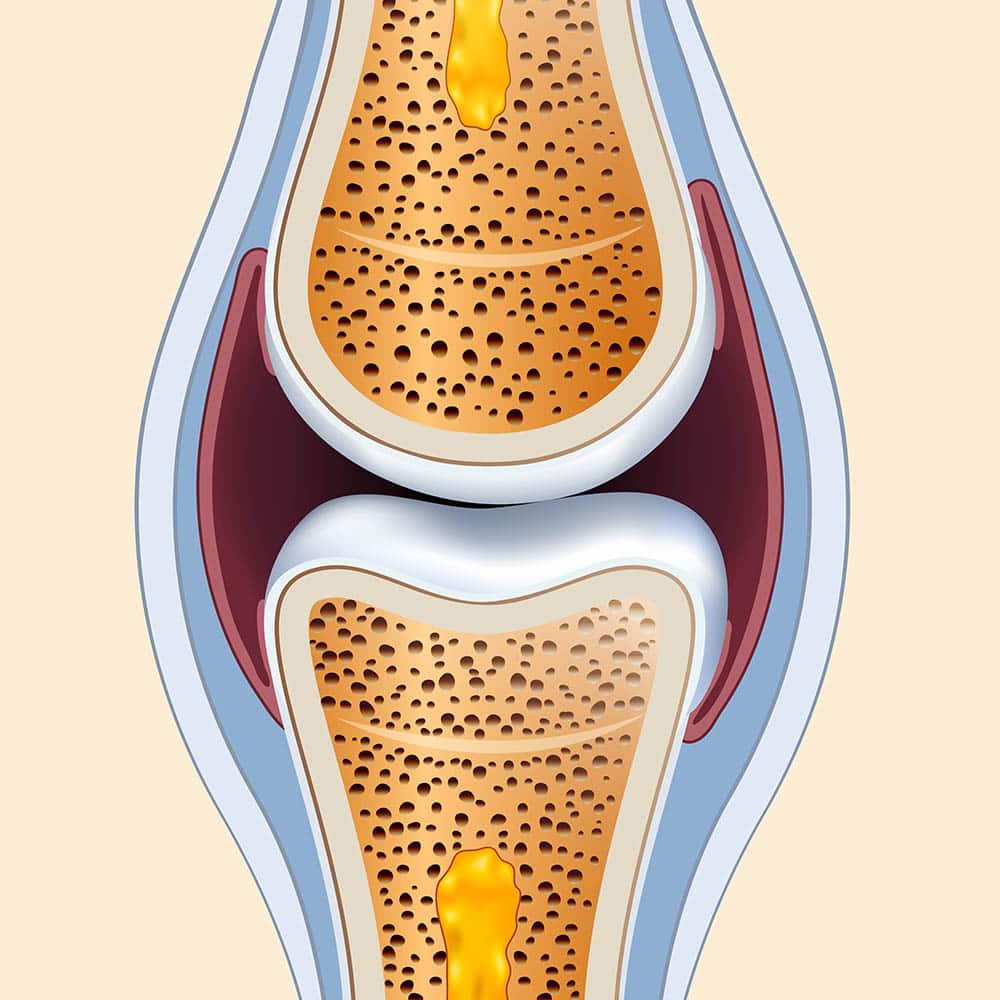 Ilustração de articulação. Em vermelho, a membrana sinovial, que inflama em casos de artrite.