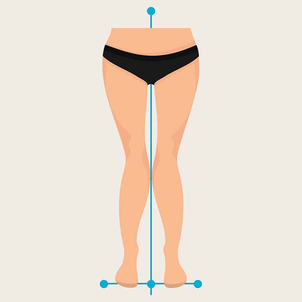 Ilustração demonstrando joelho valgo, ou em X, com joelhos voltados para dentro.