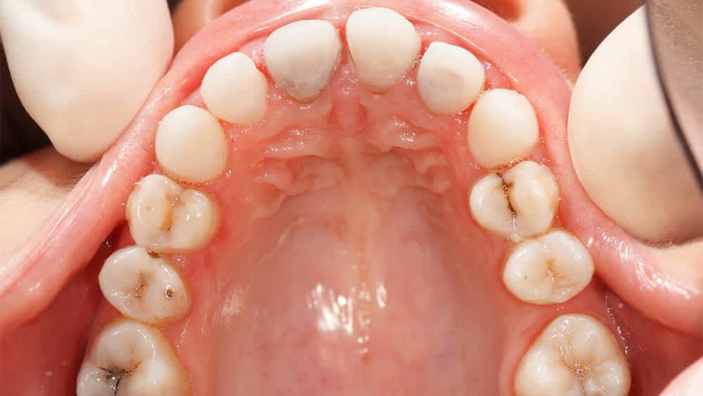 Cárie Arcada superior com dentes com cáries.