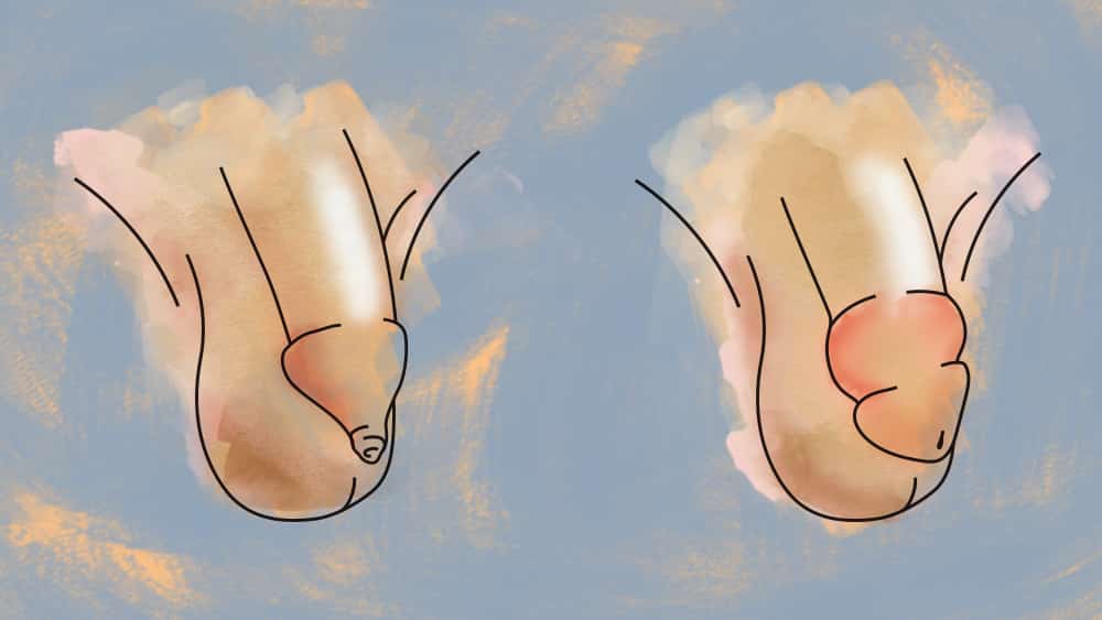 Parafimose Ilustração mostrando diferença entre fimose e parafimose.