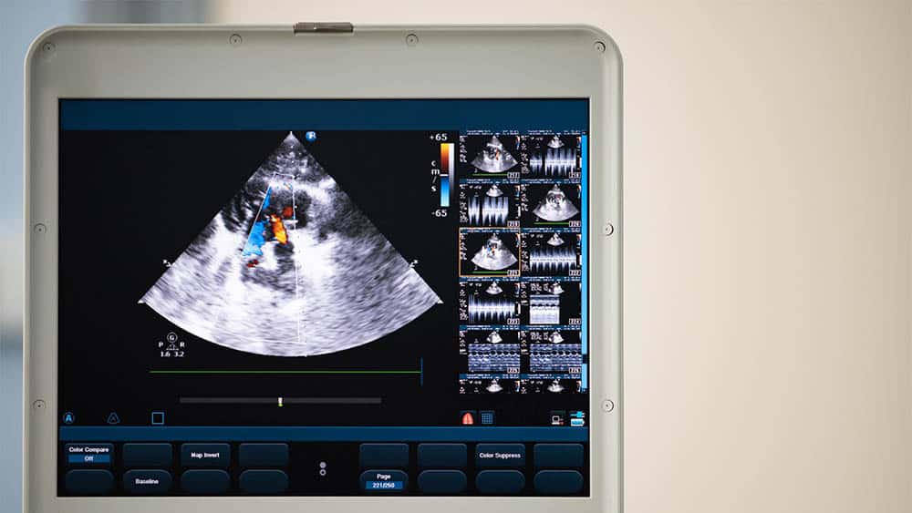 Tela de monitor com imagem de ecocardiograma.