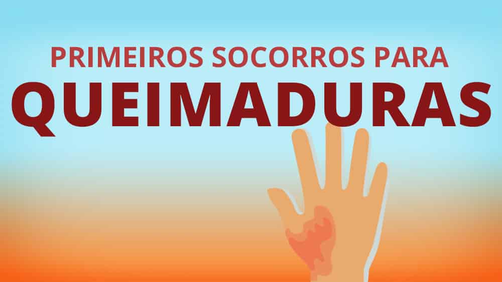 O que fazer em caso de queimadura | Infográfico infográfico sobre queimaduras