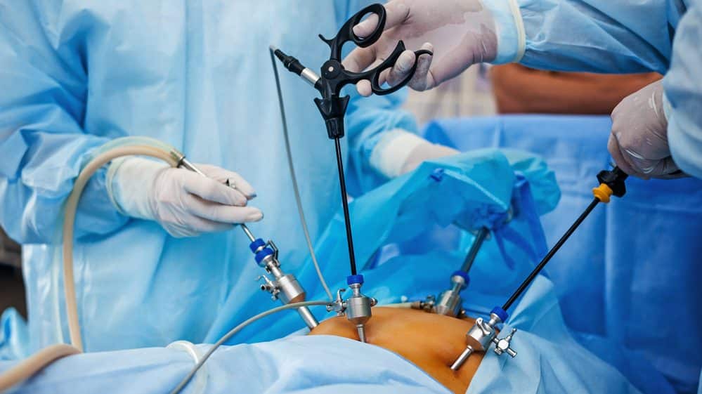 Cuidados necessários após a bariátrica Cirurgia de abdômen por laparoscopia, método usado em cirurgia bariátrica.